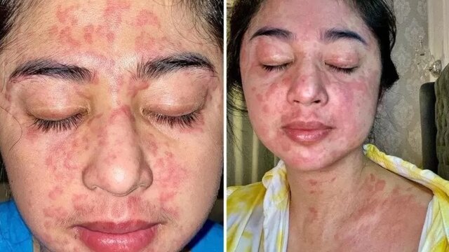Kulit Ruam Kemerahan Pada Dewi Perssik Disebabkan Efek Samping Covid-19 yang Pernah Dia Alami