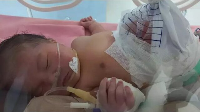 Bayi Hanania Terlahir Dengan Usus Keluar Butuh Uluran Tangan